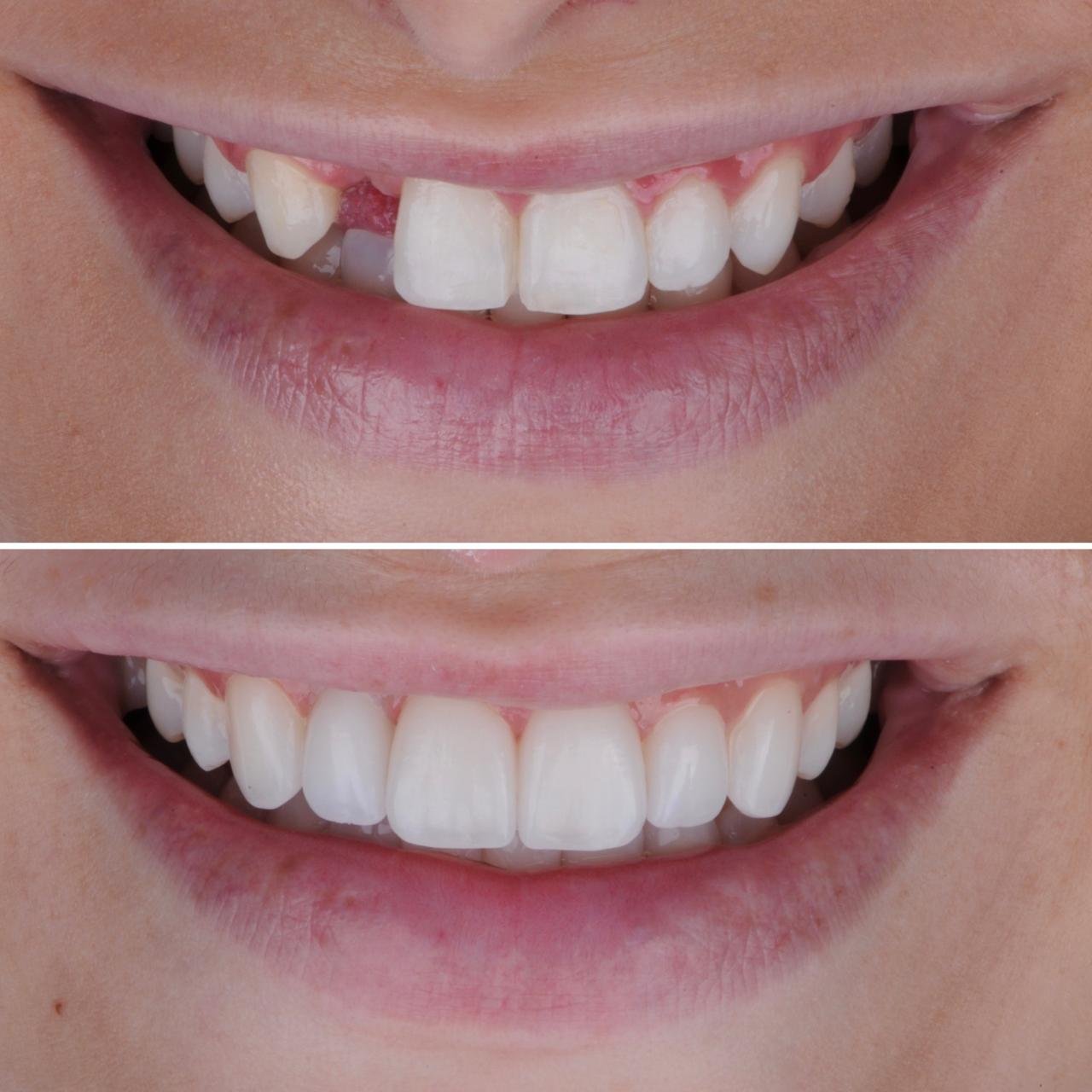 Implante Dental Cascavel